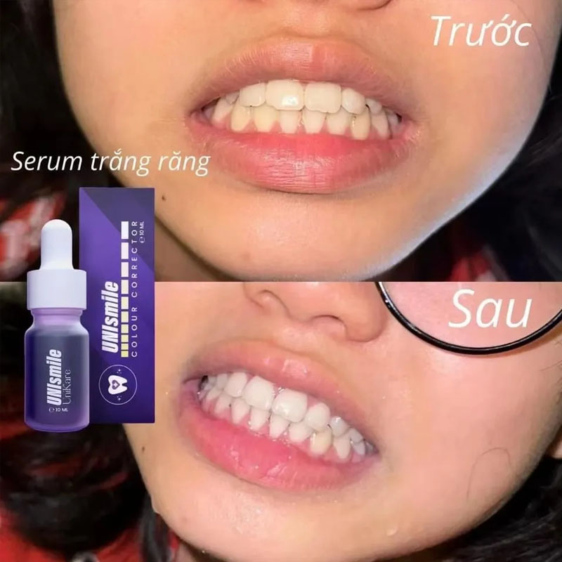 جوهر تبييض الأسنان Unismile 10 - مراجعة Teeth Whitening Effective وسعره