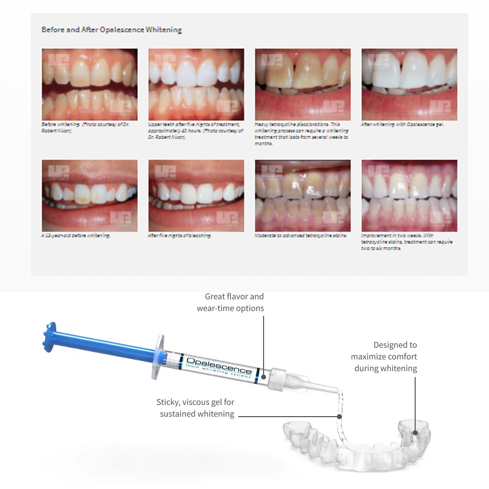 مجموعة جل تبييض أوباليزانس ، م - مراجعة Teeth Whitening Kit At Home وسعره
