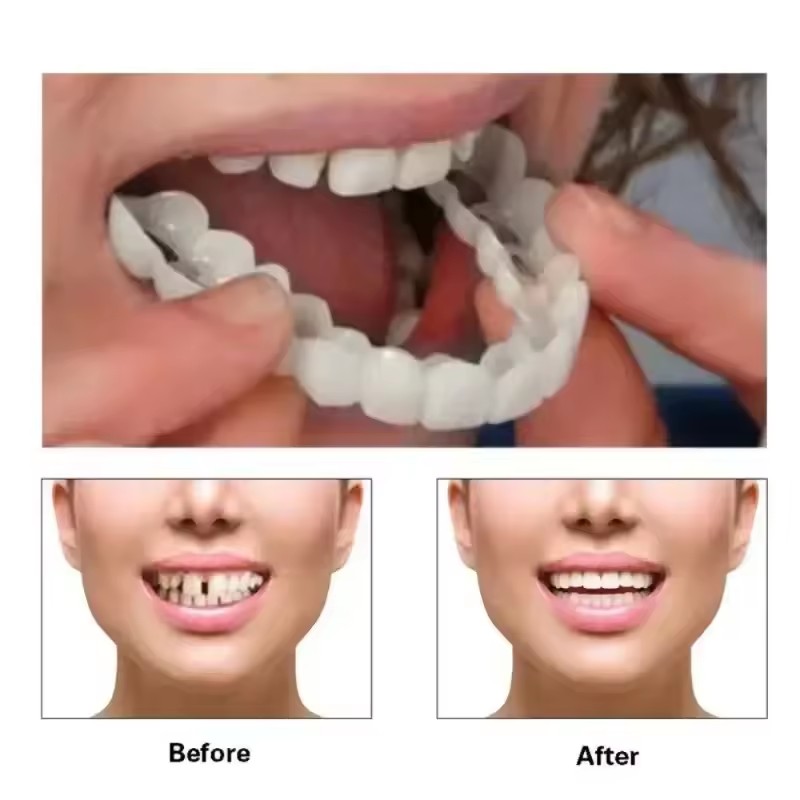 أطقم أسنان اصطناعية مؤقتة لتبي - مراجعة Teeth Whitening With Braces وسعره
