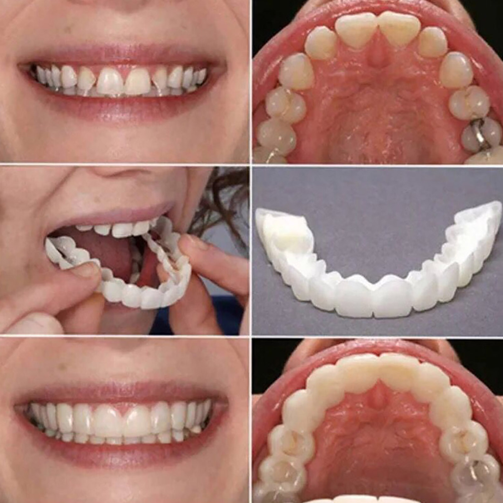 طقم أسنان اصطناعية مؤقتة لتبيي - مراجعة Teeth Whitening With Braces وسعره