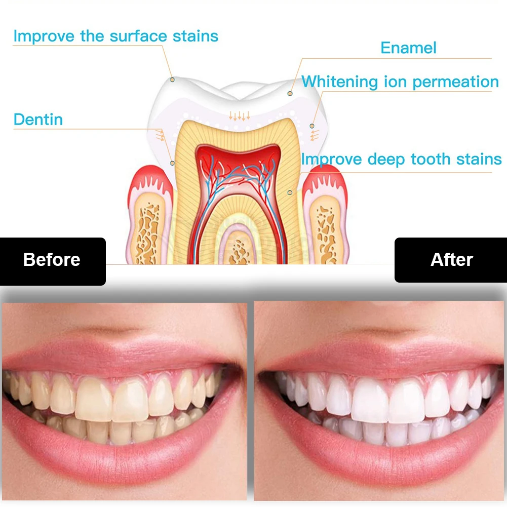 طقم تبييض الأسنان صغير 16 LED  - مراجعة Teeth Whitening Kit With Light وسعره