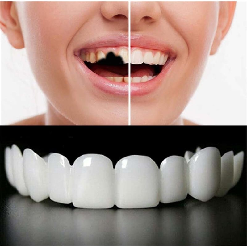 [جديد! ABMK] زوجان، أطقم أسنان - مراجعة Teeth Whitening With Braces وسعره