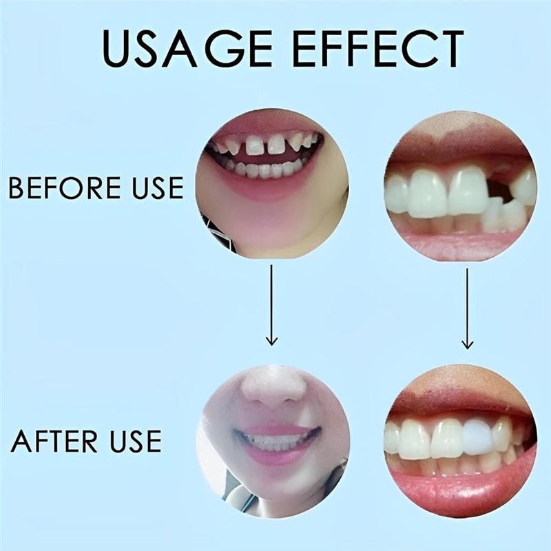 [جديد! ABMK] زوجان، أطقم أسنان - مراجعة Teeth Whitening With Braces وسعره